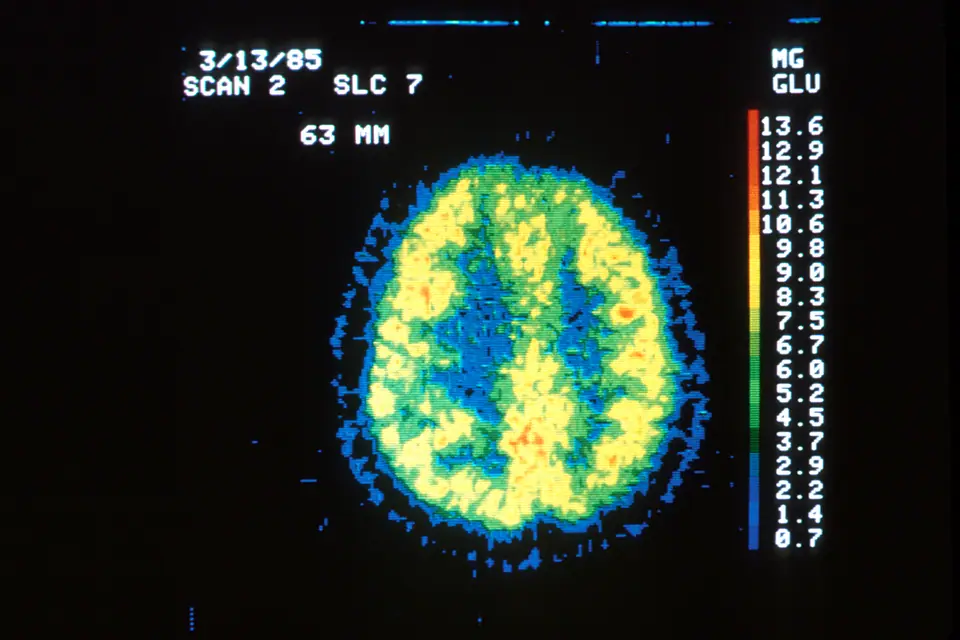 Tomografía por emisión de positrones de un cerebro sano: los colores muestran cuánta glucosa consume cada zona
