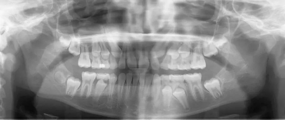 Radiografía panorámica de un niño con dentición mixta: dientes de leche en la boca y los definitivos formándose debajo, dentro del hueso